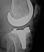 Left knee TKA postoperative radiograph