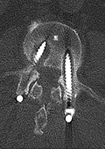 PLIF loosening axial CT 