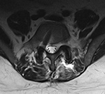 PLIF misplaced screw MRI axial
