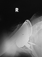 Reverse total shoulder arthroplasty posterior dislocation