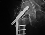 Right hip dynamic compression screw settling