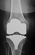 Right TKA 6.5 years after surgery