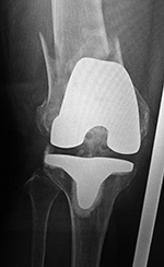 Right femur TKA periprosthetic fracture
