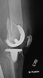 Right femur TKA periprostheticfracture