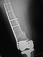 Right femur periarticular plate