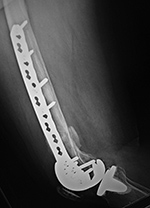 Right femur periarticular plate