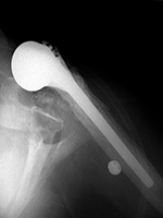Right shoulder hemiarthroplasty anterior dislocation