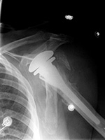 Right shoulder hemiarthroplasty anterior dislocaton