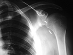 Displaced suture anchors