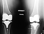 Bilateral loosening of TKA,s