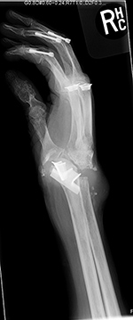 Disrupted Silastic wrist prosthesis