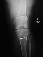 ACL repair