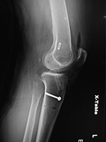 ACL repair