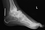 Achilles tendon lengthening pin