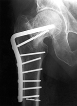 Blade plate
