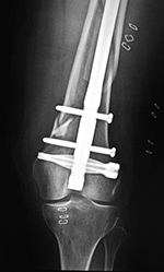 Spiral distal locking screw