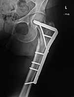 Femur blade plate and interfragmentary screw