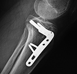 Tibia buttress plate