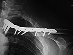Left clavicle reconstruction plate