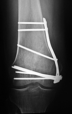 Right femur buttress plate