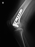 Right femur buttress plate