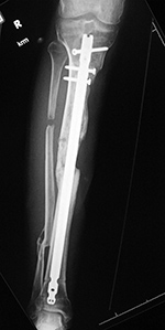 Right tibia dynamization - after