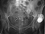 Sacral stimulator