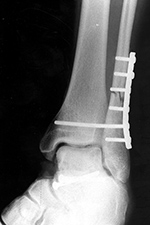 Syndesmotic screw and dynamic compression plate