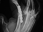 Failed MCP joint arthroplasties