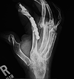Failed MCP arthroplasties