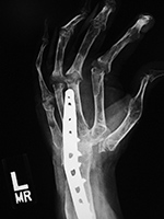 Left wrist arthrodesis