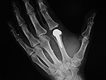 Left second MCP joint prosthesis