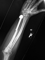 Left forearm reconstruction