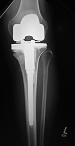 Left knee cruciate substituting revision knee arthroplasty