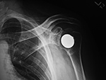 Left humeral head hemi-cap