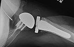 Left shoulder reverse total shoulder arthroplasty