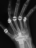 Wrist and finger prostheses