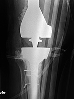 Right knee revision arthroplasty