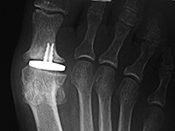 Right large toe hemiarthroplasty