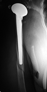 Right shoulder periprosthetic fracture