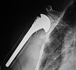 Right shoulder hemiarthroplasty