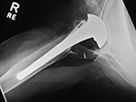 Right shoulder hemiarthroplasty