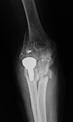 Right radial head prosthesis loosening