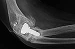 Right radial head prosthesis loosening