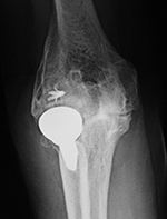 Right radial head prosthesis