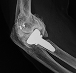 Right radial head prosthesis