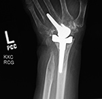 Third generation total wrist arthroplasty
