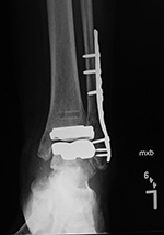 Zimmer trabecular metal TAR