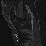 Susceptibility artifact